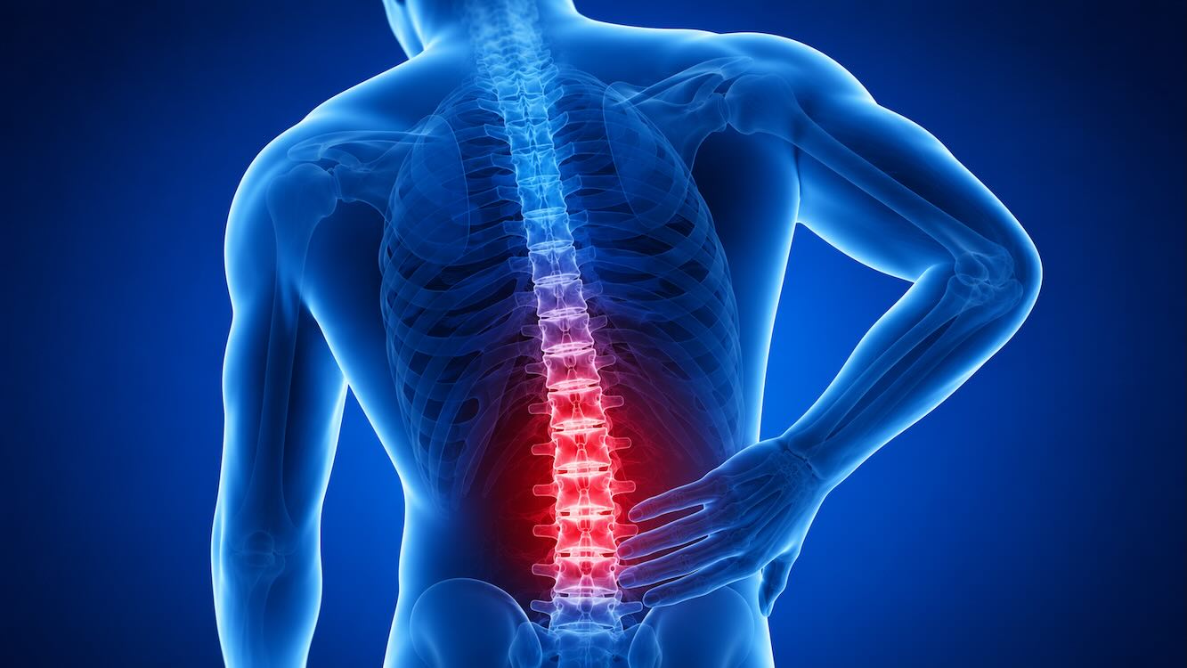 cauda equina syndrome
