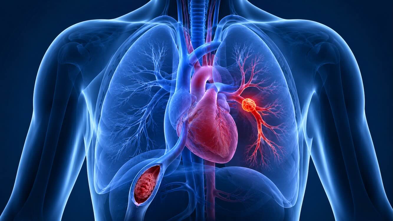 Pulmonary Embolism misdiagnosis