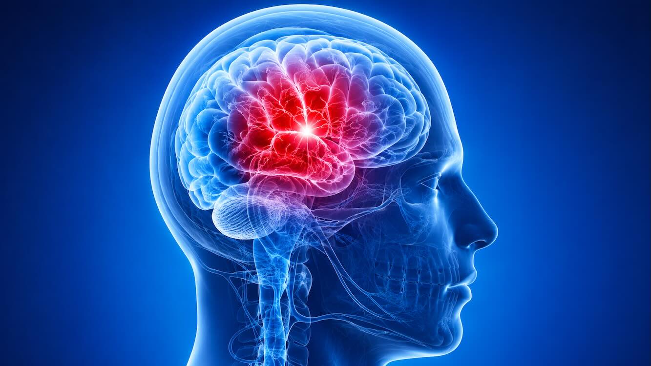 stroke misdiagnosed as vertigo